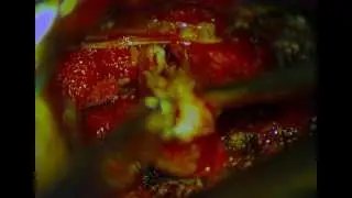 L5S1 lumbar discectomy