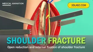 Open Reduction and Internal Fixation for Shoulder Fracture | 3D Medical Animation