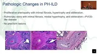 PH in ILD: Finally some hope?- Kristin Highland, MD