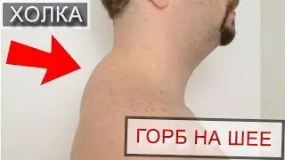 Холка на шее - вдовий горбик (гормональный горбик, климактерический, эстетический). Радион Игнатьев
