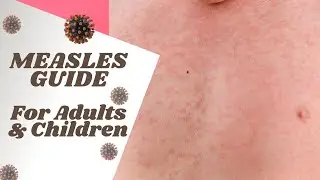 Measles Symptoms, Causes, Diagnosis, Treatment & Prevention