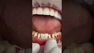 Veneers for Chipped Teeth: A Game-Changer