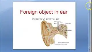 ENT Foreign Object Ear Canal Child seed grain chalk vegetable Method removal Insect Live chloroform