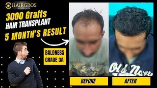 Hairgros Hair Transplant Result | 3000 Grafts FUE | Hairgros Bahadurgarh | Rohtak | Ramnagar