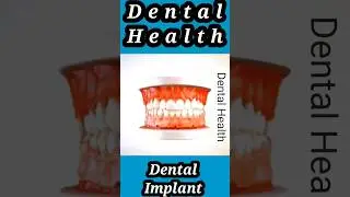 Dental Implants #Shorts #viral #tiktok #viralvideo #how #foryou #dental #4k #1m