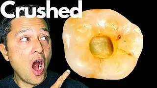 Mandibular Molar - Radix Entomolaris - Root Canal Treatment