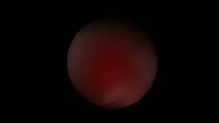 La ponction fluoroscopique percutanée endoscopique trans-pyélique de l’uretère proximal.