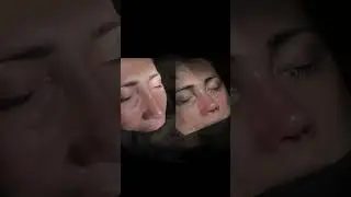 Revision Rhinoplasty Before After: Allogenic rib cartilage used for nasal reconstruction