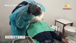 Tratamiento Bichectomia