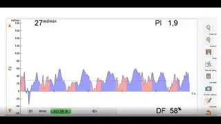 Request Case 5: Graft patency verification with flow measurement