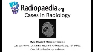 Dyke-Davidoff-Masson syndrome (Radiopaedia.org) Cases in Radiology