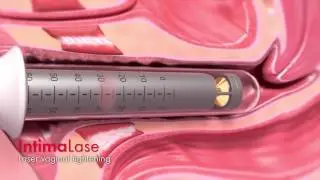 Láseres Fotona - Ginecología - RenovaLase® e IntimaLase®
