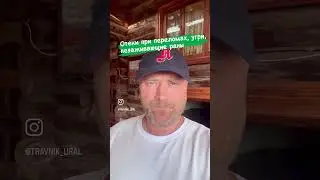 Отеки при переломах, угри..