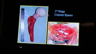Periprosthetic infection