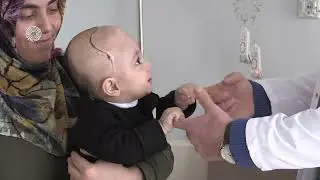 Van’da Kafatasında Şekil Bozukluğu Olan 7 Aylık Bebek Ameliyat Edildi