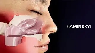 Turbinoplasty: Radiofrequency reduction, Microdebrider resection, Partial resection / KAMINSKYI
