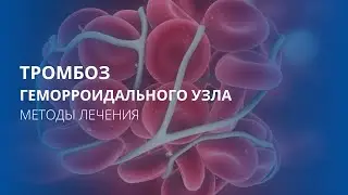 Тромбоз геморроидальных узлов. Методики лечения.
