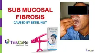 Trismus Care with TrisCaRe by Dr  Pawan Gupta