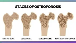 The Truth About Osteoporosis with Pharmacist Ben Fuchs