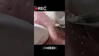 🤔 Забитые поры на носу.