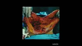 HIGH DEFINITION LIPOSUCTION WITH TUMMY TUCK SURGERY RESULTS !