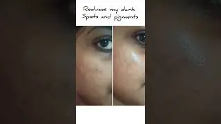 Testing 5% Niacinamide serum on my acne scars for 80 days❤️😍 