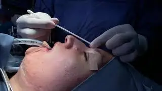 HABLEMOS DE CIRUGIA PLASTICA: RINOPLASTIA