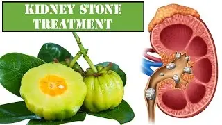 Compound Found in Citrus Fruit could End Kidney Stones | Kidney Stone Treatment