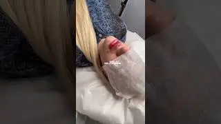 #контурнаяпластикагуб