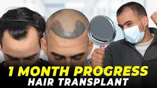 Hair Transplant in Hyderabad | Best Results & Cost of Hair Transplant in Hyderabad