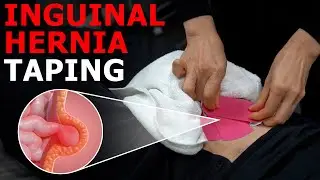 Easy Support for Inguinal Hernia: A Physical Therapist’s Expert Guide