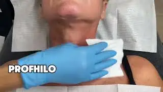 Wat is Profhilo?