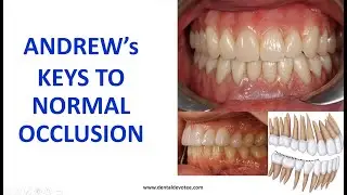 Andrew's Keys To Normal Occlusion