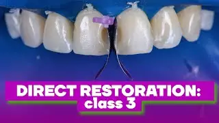 Direct restoration: class 3  | BG Dental Cases #31