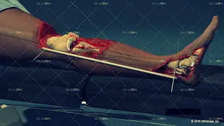Motorcyclist Struck by Drunk Driver