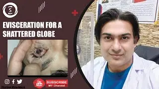 Evisceration for a shattered globe