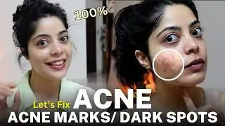How I get rid of Acne, Acne Spots & Dark Spots ? Products that ACTUALLY WORKS
