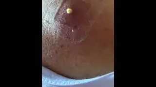 Black head removal on face - Blackheads on back treatment