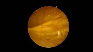 Ureteric jets at cystoscopy