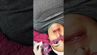 preenchimento labial passo a passo.