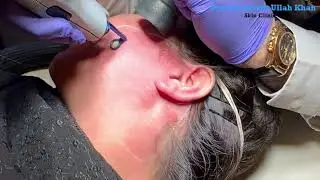 Bye-Bye Red Birthmark! Pulsed Dye Laser Faded My Port Wine Stain#portwinestain #lasertherapy