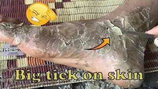 How to removal skin | callus removal skin flakes #45