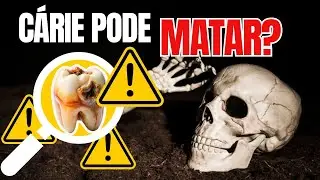 OS PERIGOS DA CÁRIE. REMOVA A SUA CARIE. #dentista #ODONTOLOGIA #REMOVERCARIE #SAUDE #alerta