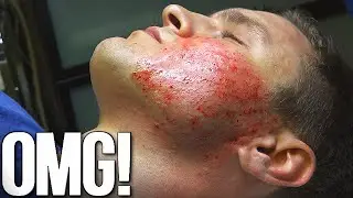 Well, That Was Bloody | My Acne Scar Surgery (DermaPen)