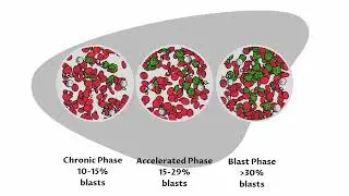 Treatment Options for Chronic Myeloid Leukemia (CML) -