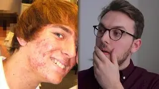 My Bad Acne
