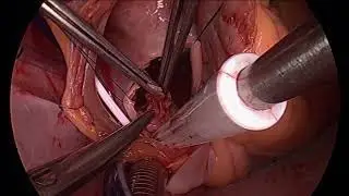 Surgical Treatment of a Huge Left Atrial Myxoma