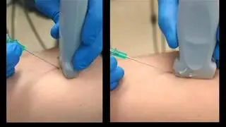 US Guided Peripheral Cannulation NEJM