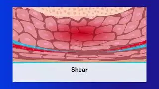 Pressure Injury Education: Chapter 2 Cause