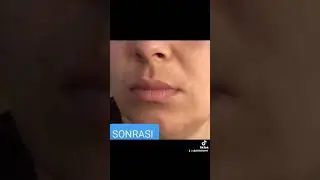 leke kremi setimizden gelen memnuniyet videosu #leketedavisi